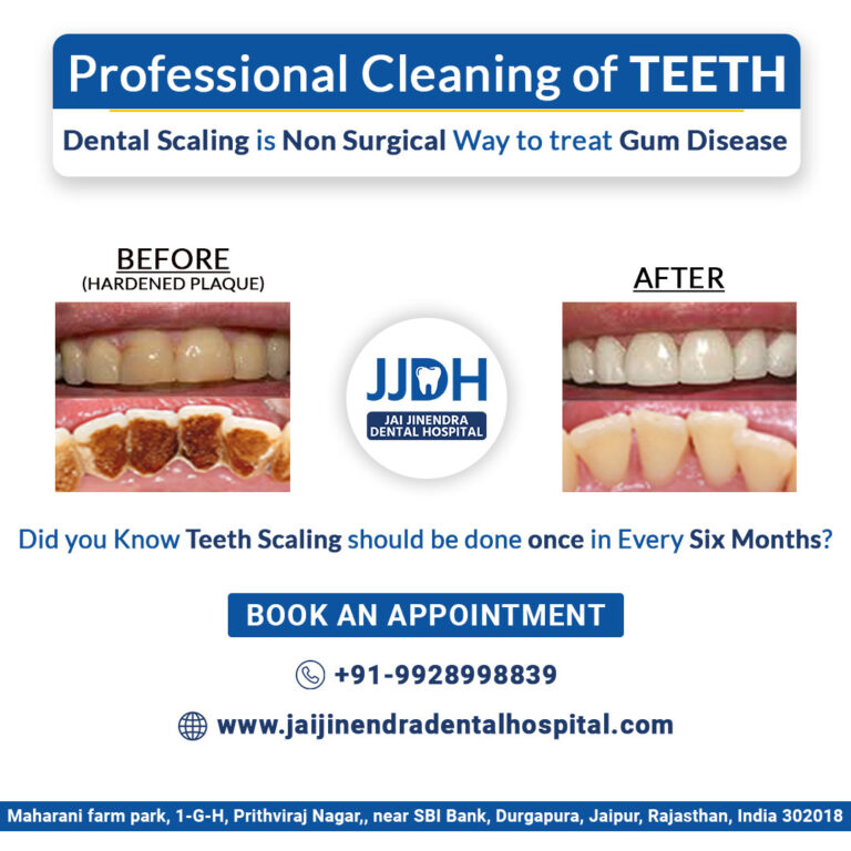 Dental Scaling Jai Jinendra hospital Jaipur 768x768