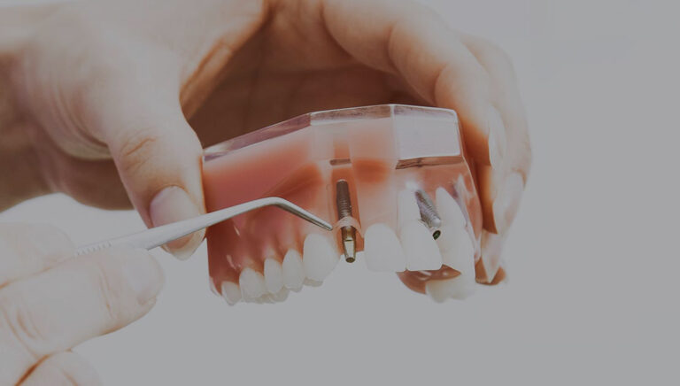 Dental Implants Auckland 768x436