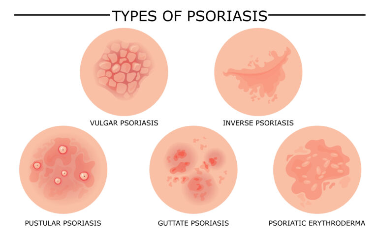 13683159 Different types of psoriasis vector set 768x488
