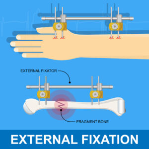 External Fixators in Orthopedics 300x300 1