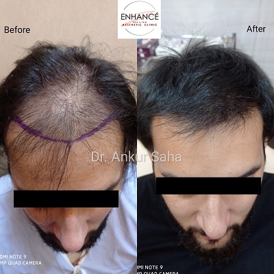 FUEHair Transplant BA 02.85c4e5cb33a02ff82949
