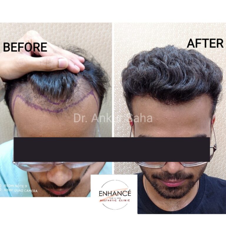 FUEHair Transplant BA 05.f2d7a478f1d6aae5a70e 768x768
