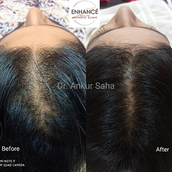 Hair Loss BA 05.0e0808c542834f9b927b