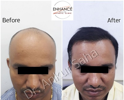 Hair Loss BA 06.dcab31b5838ec6f3b732