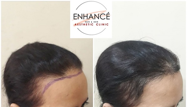 Hair Loss BA 13.e8119986d83f4d39b7af