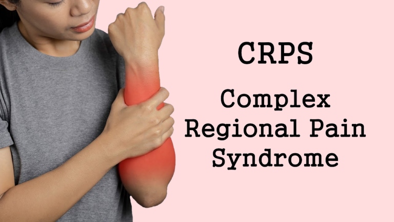 complex pain regional syndrome 768x432