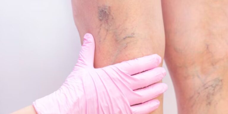 Spider Veins vs Varicose Veins 768x384