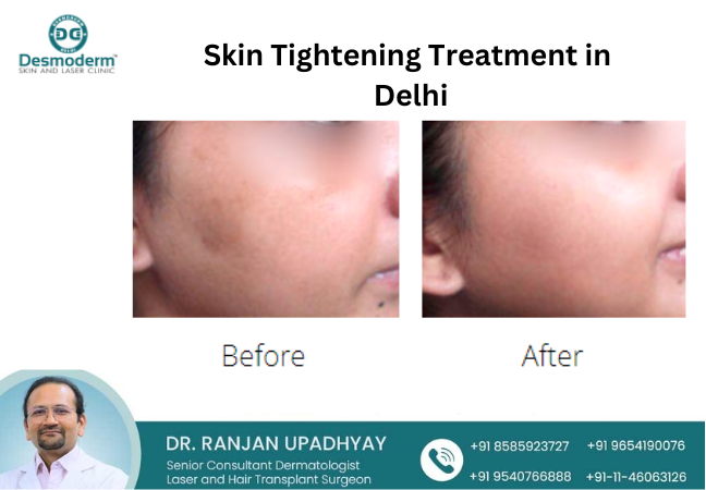 skin tightening treatment in delhi desmoderm