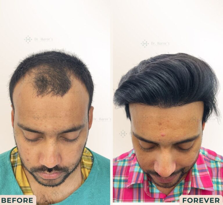 After Before 1 5 768x709