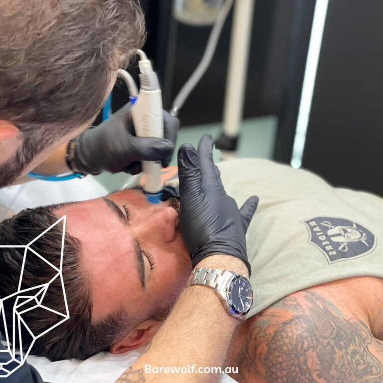 Best Mens Dermapen Sydney Effective Skin Therapy 768x768