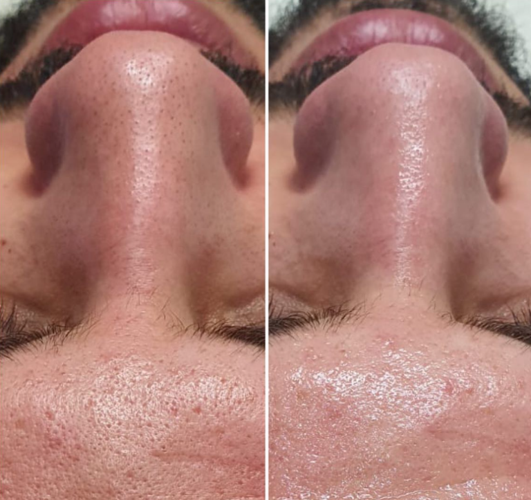 Look Refreshed with Mens Fillers Sydney – Book Now 768x723