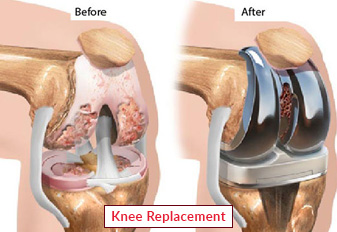 1681194888knee replacement 8 1