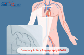 1711634899coronary artery angiography cag