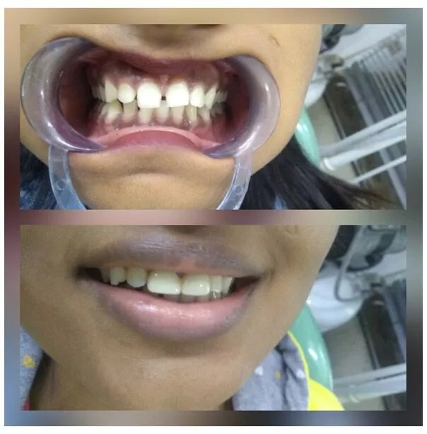 COVERING MID LINE DIASTEMMA GAPS