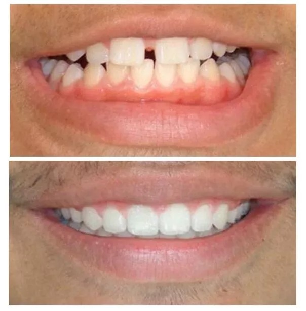 MAKING HIM SMILE CONFIDENTLY VIA VENEERS