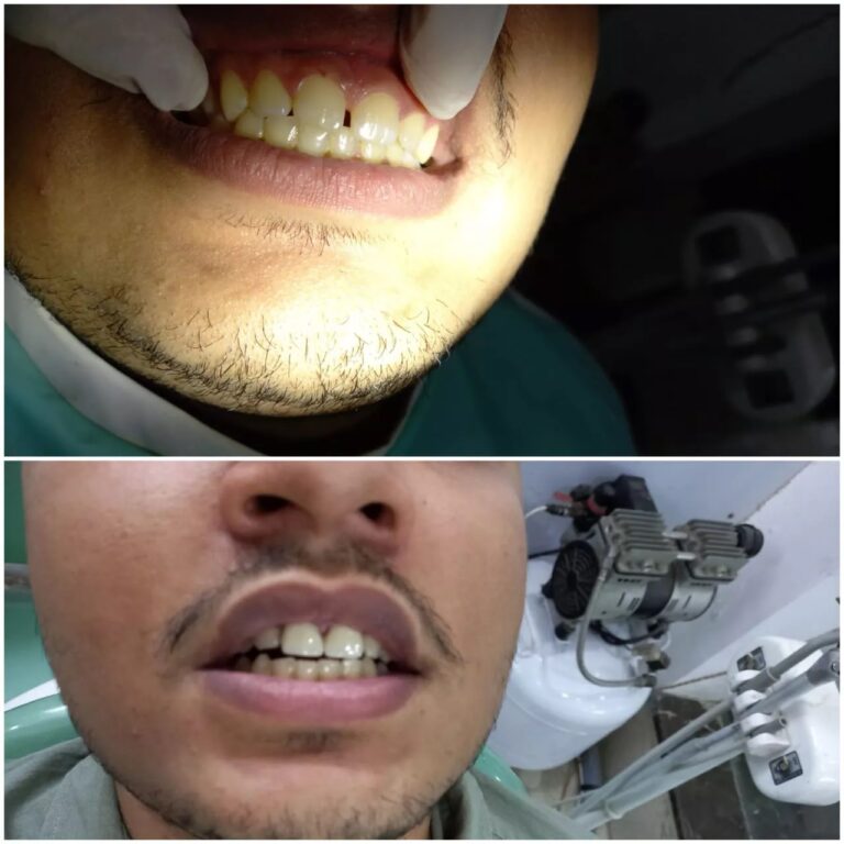 Midline diastemma correction via aesthetic zirconia crowns 768x768