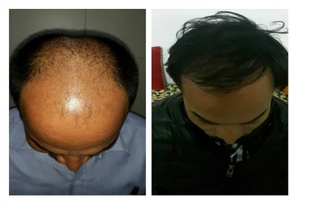direct hair transplant 500x500 1