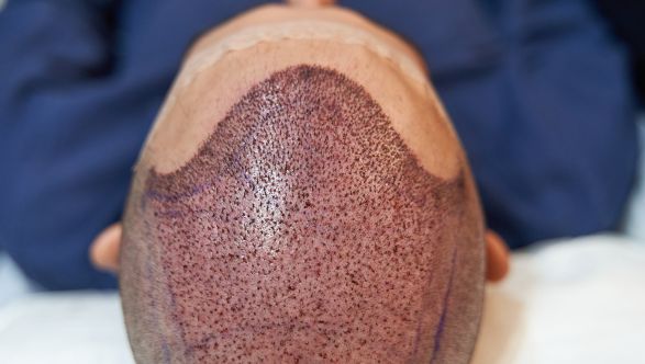 hair transplant 1 3