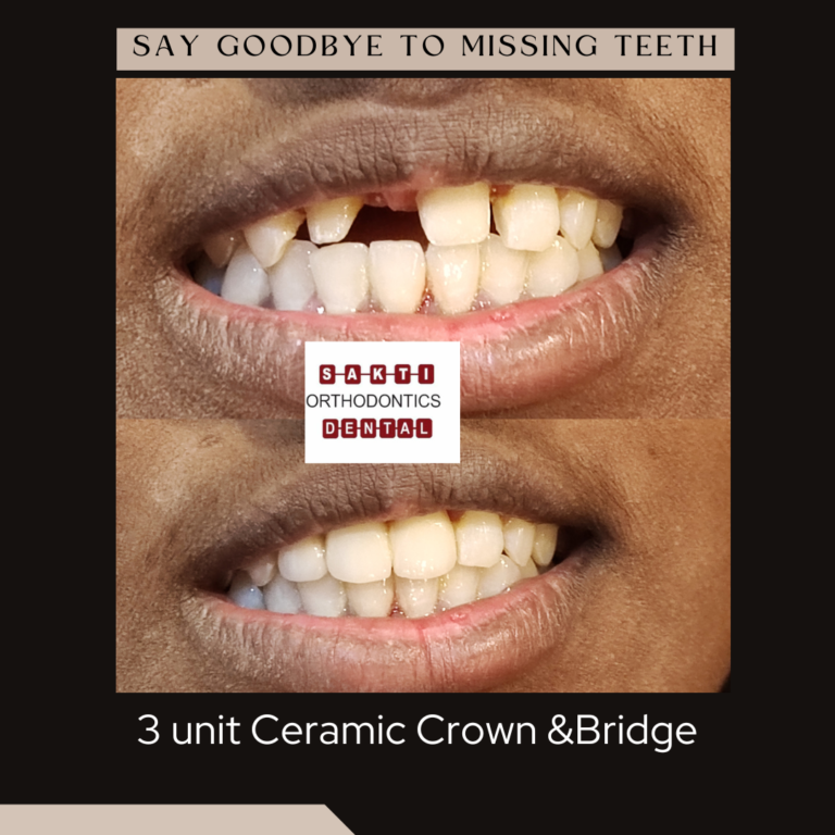 ceramic bridge 768x768