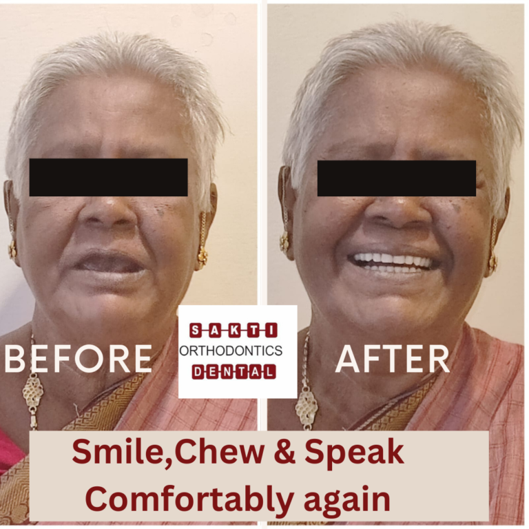 complete denture sakti Dental 768x768