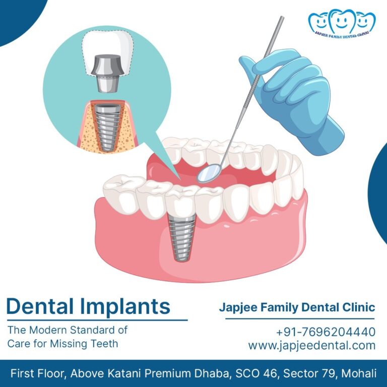 Dental implants in Mohali 768x768
