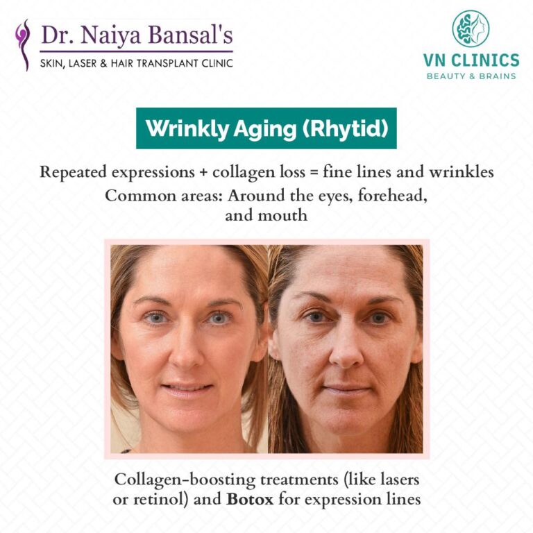 Dr Naiya Bansals Skin Laser Centre At VN Clinics Anti Aging Treatment in Mohali 5 768x768