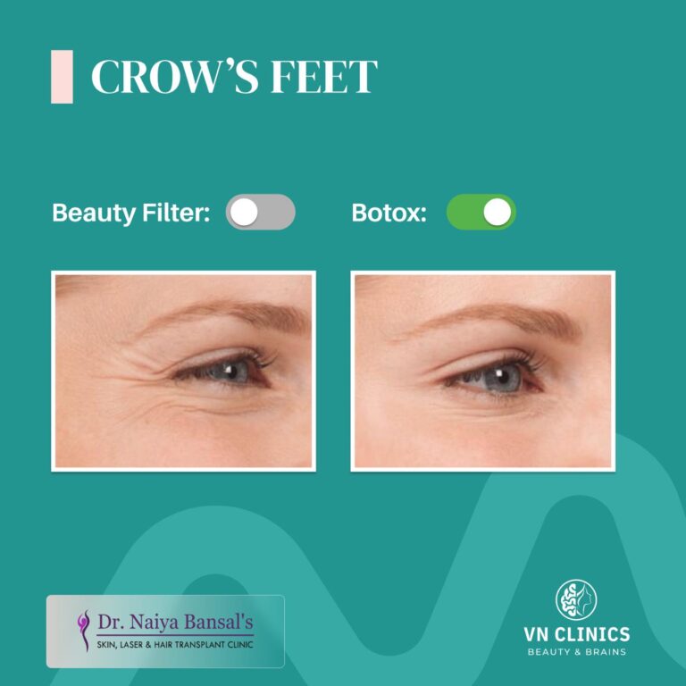Dr Naiya bansal Botox treatment in Mohali 768x768