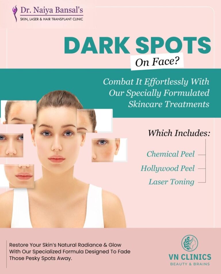 Dr Naiya bansal Chemical Peel Treatment in Mohali 768x952