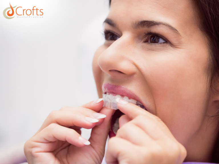 Invisalign eeex 768x576