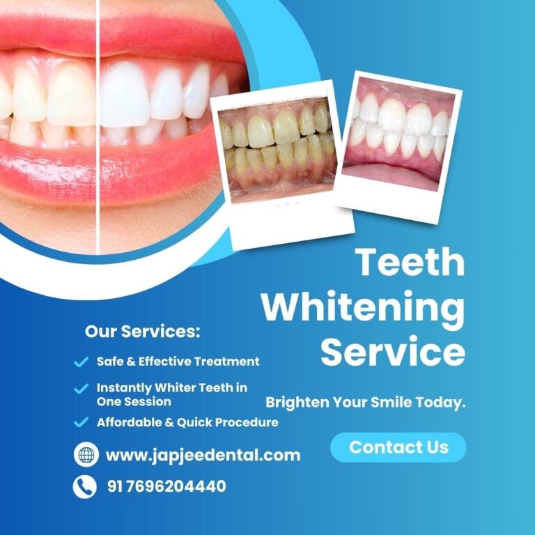 Japjee Family Dental Clinic Teeth whitening treatment in Mohali Chandigarh 768x768