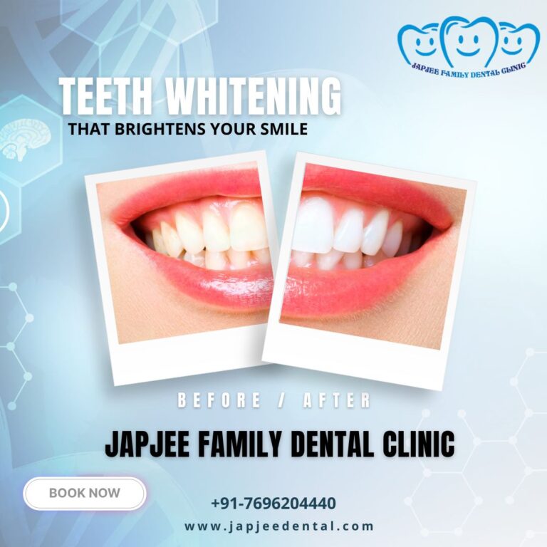 Japjee family dental clinic Teeth whitening treatment in Mohali 768x768