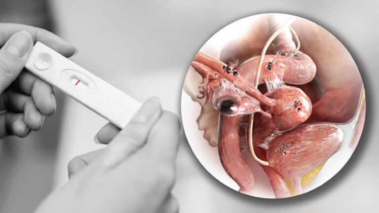 endometriosis and infertility 768x432