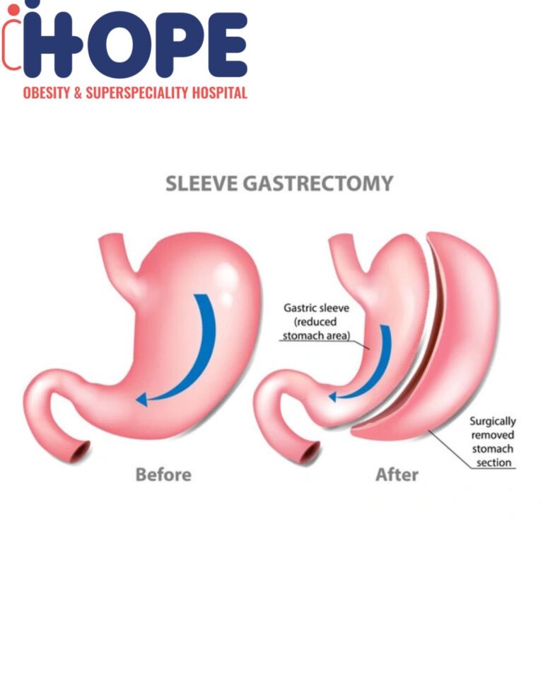 Gastric sleeve surgery offpage image 14 5 25 768x960