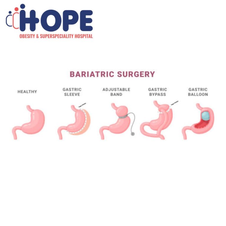 bariatrci surgery offpage image 14 5 25 768x768