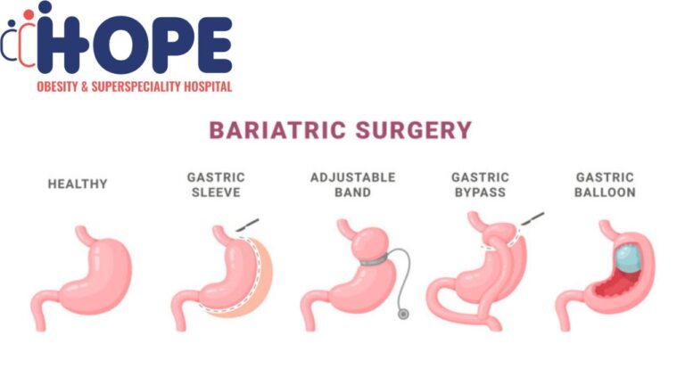 bariatric surgey offpage image 5 6 25 768x432