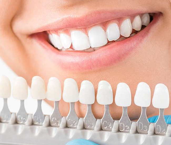 full mouth dental implants dr naganna nagu dental bangalore