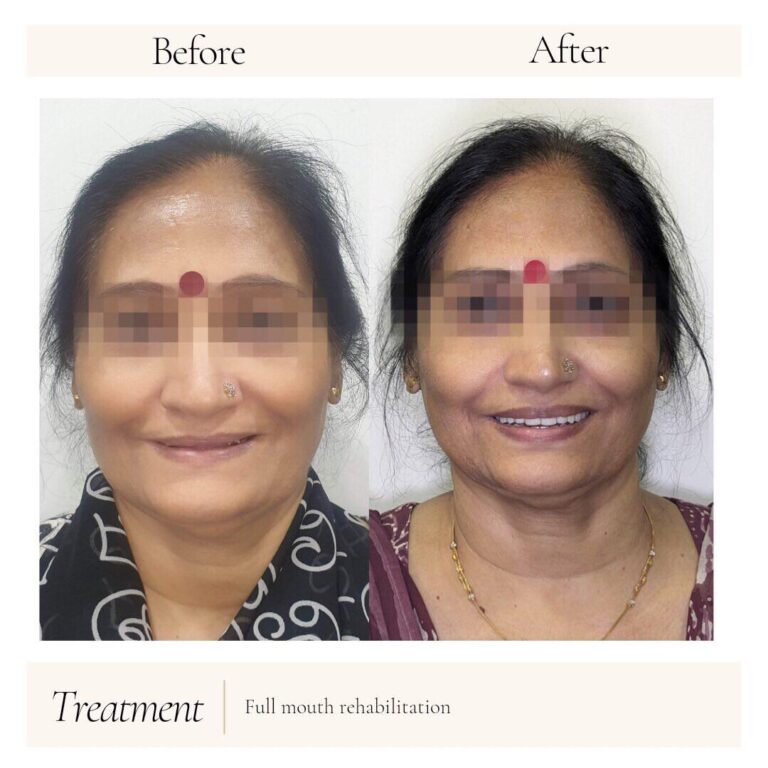 full mouth rehabilitation treatment in chembur east mumbai maharashtra india 768x768