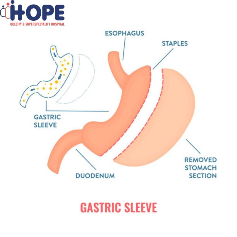 gastric sleeve offpage image 23 6 25 768x768