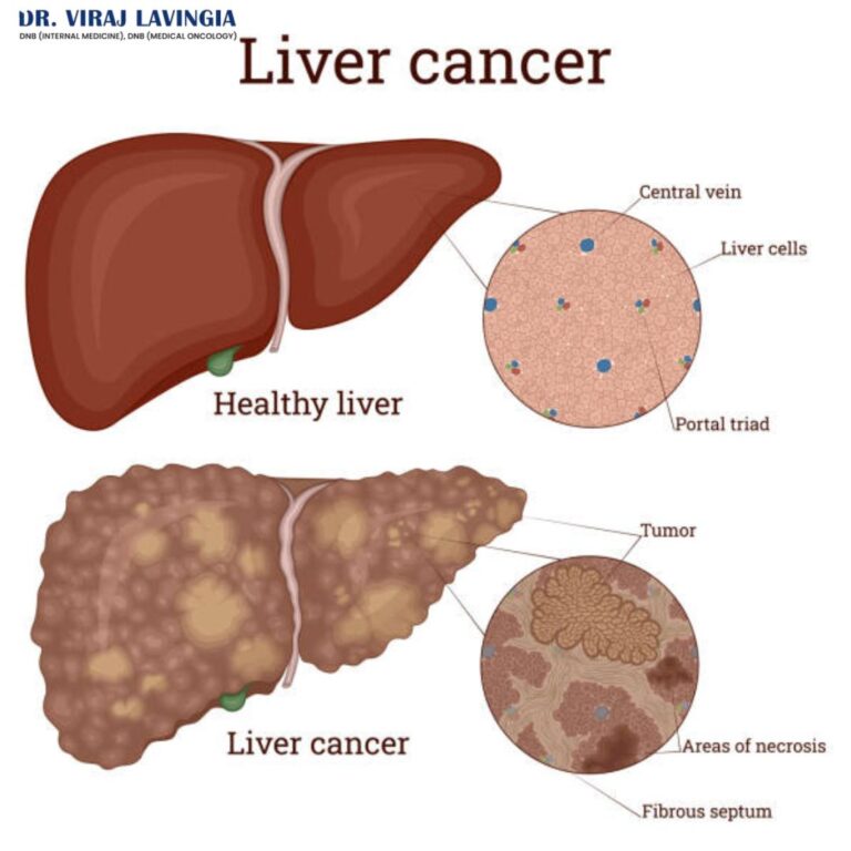 liver cancer offpage image 23 6 25 768x768