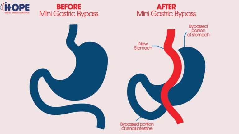 mini gastric surgery offpage image 16 6 25 768x432
