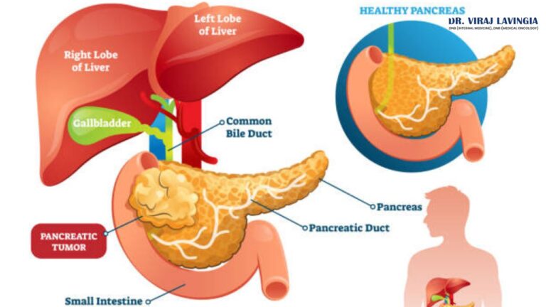 pancreatic cancer offpage image 27 6 25 768x432