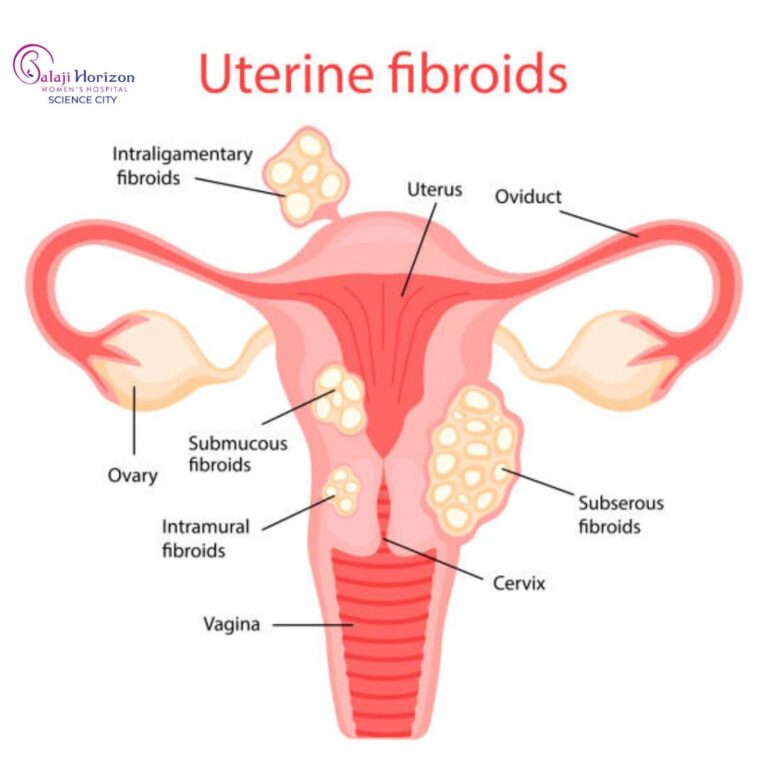 uterine fibroids offpage image 18 6 25 768x768