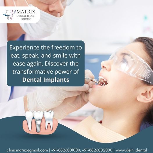 Best Dental implants in delhi