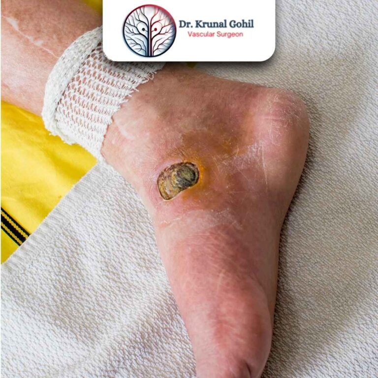 Diabetic Foot Treatment Dr. Krunal Gohil 768x768