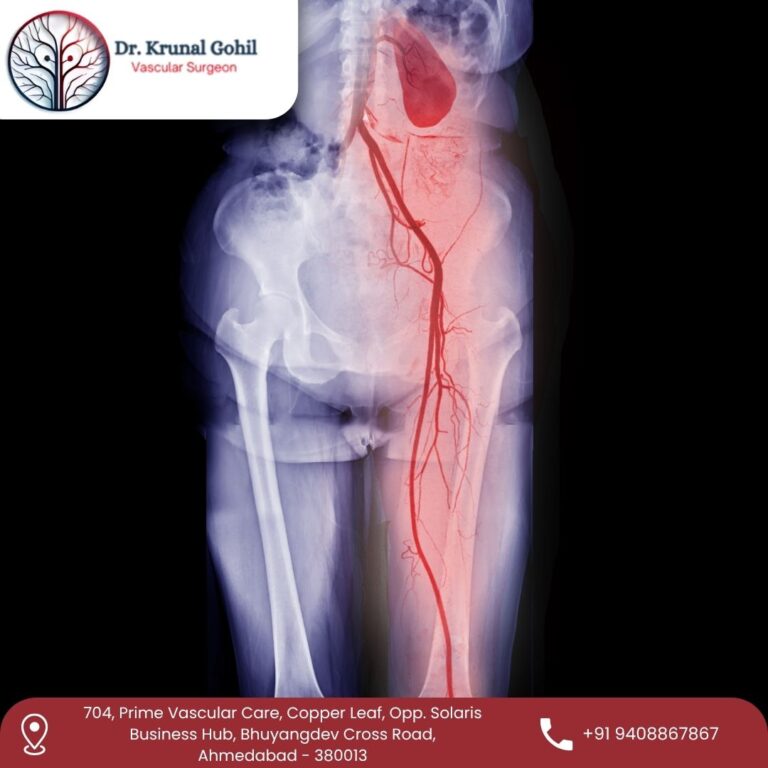 Peripheral Arterial Disease Dr. Krunal Gohil 768x768
