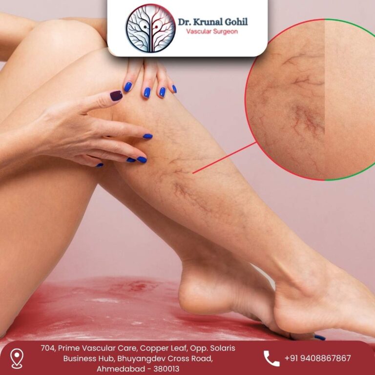 Varicose Veins Treatment Dr. Krunal Gohil 768x768