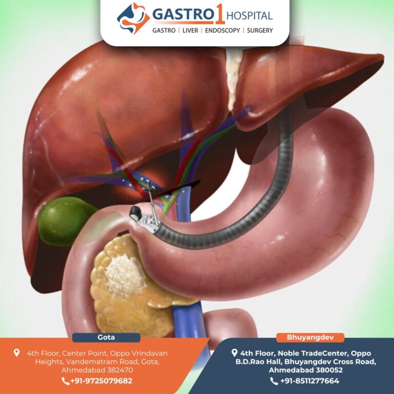 BestDoctorForERCPInAhmedabad Gastro1 Hospital 3 768x768