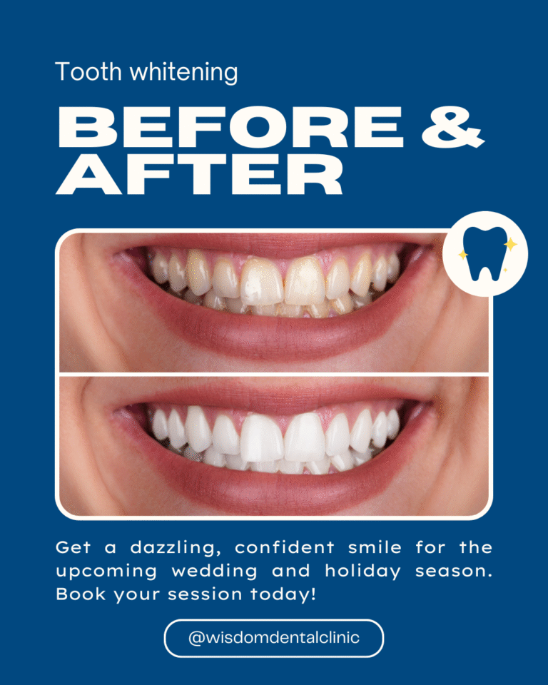 Blue and White Bold Minimalistic Tooth Whitening Before After Instagram Post 768x960