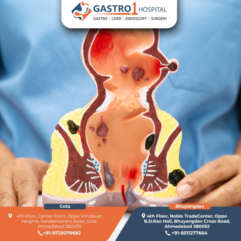 FissureDoctorAhmedabad Gastro1 Hospital 768x768