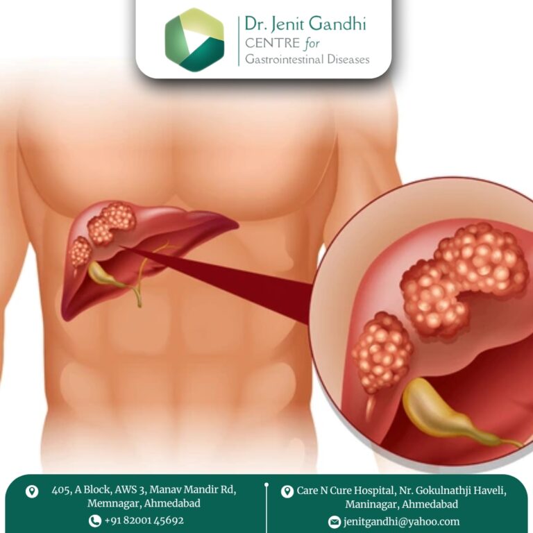 LiverCancerTreatmentAhmedabad 768x768